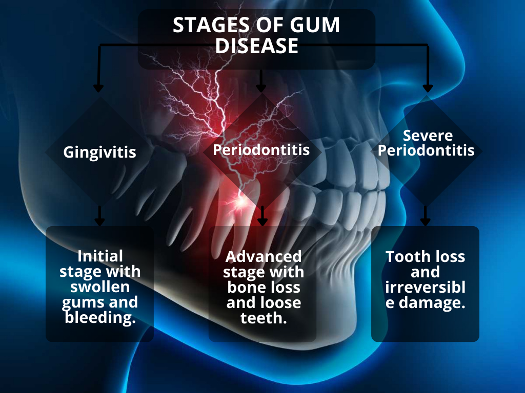 Stages of Gum Disease