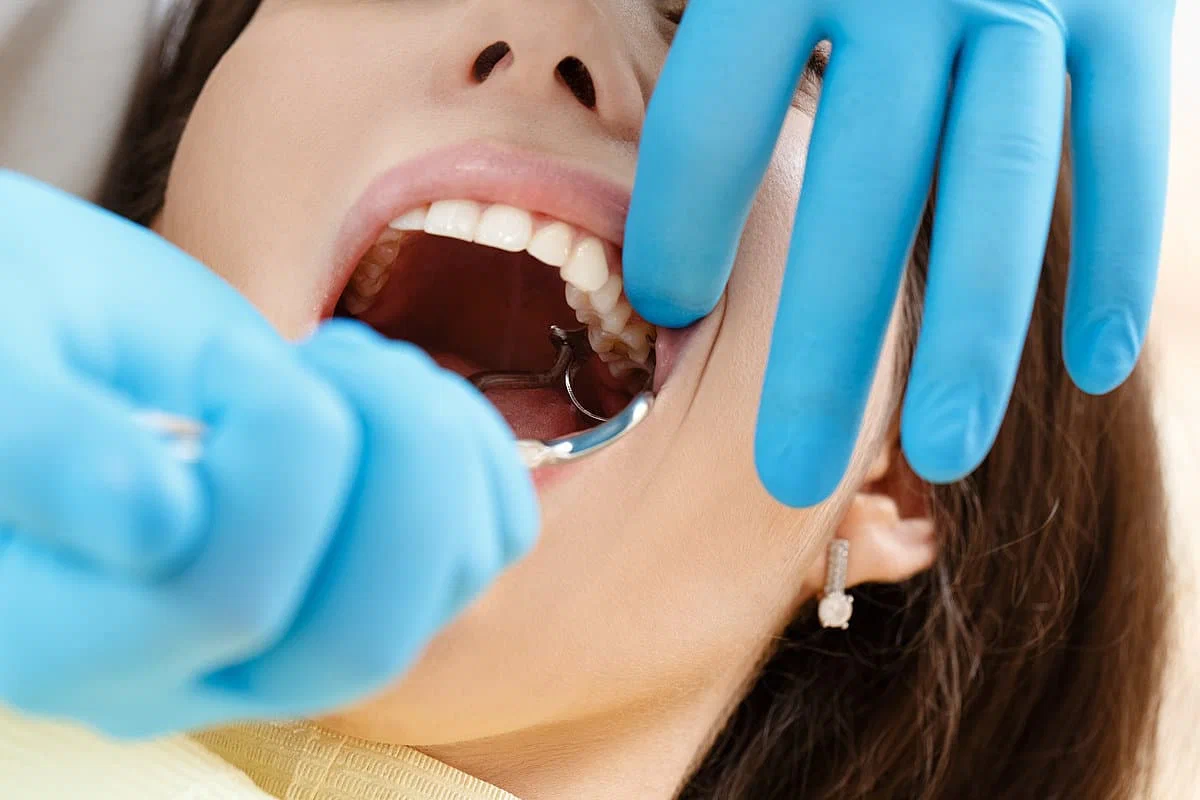 Wisdom Tooth Extraction Treatment
